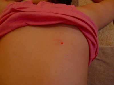 骨盤の動きを変えた背中のツボ(膈関の付近)