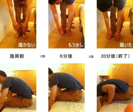 腰痛の前屈チェック(鍼灸でのビフォーアフター)