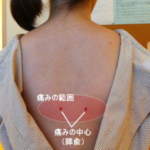 妊娠中の背中の痛み(膵兪の付近)