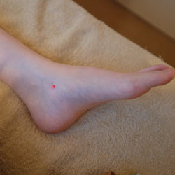 内踝の下の痛み