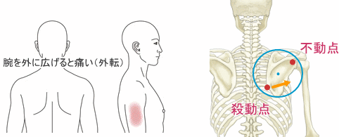 外転時痛