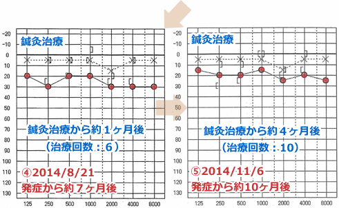 鍼灸院での突発性難聴の症例（オージオグラム２） hspace=