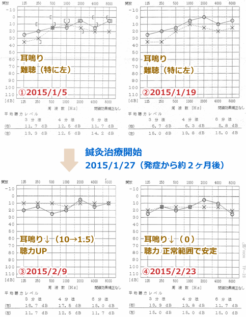 鍼治療_聴力の改善(オージオグラム)_YMMK270115