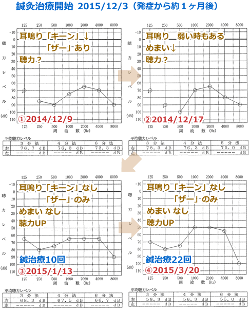 鍼治療_聴力の改善(オージオグラム)_YMYJ031214