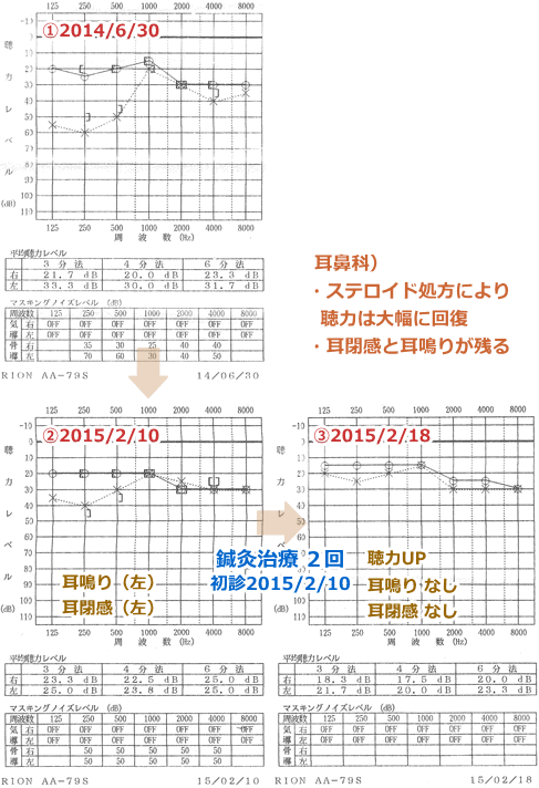 鍼治療_聴力の改善(オージオグラム)_YMYN100215
