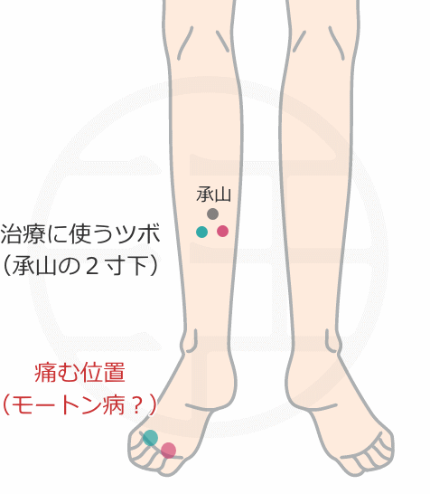 モートン病に使用するツボ