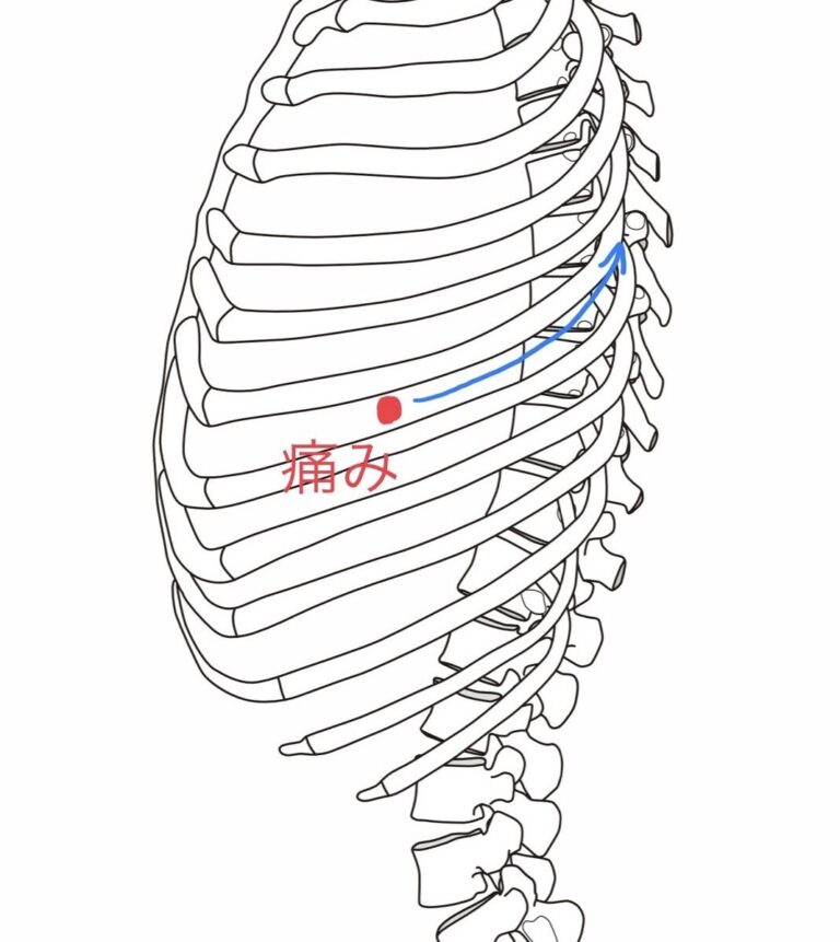肋間神経痛の治療点の探し方