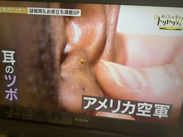 戦場鍼（NHK／ツボのトリセツ）